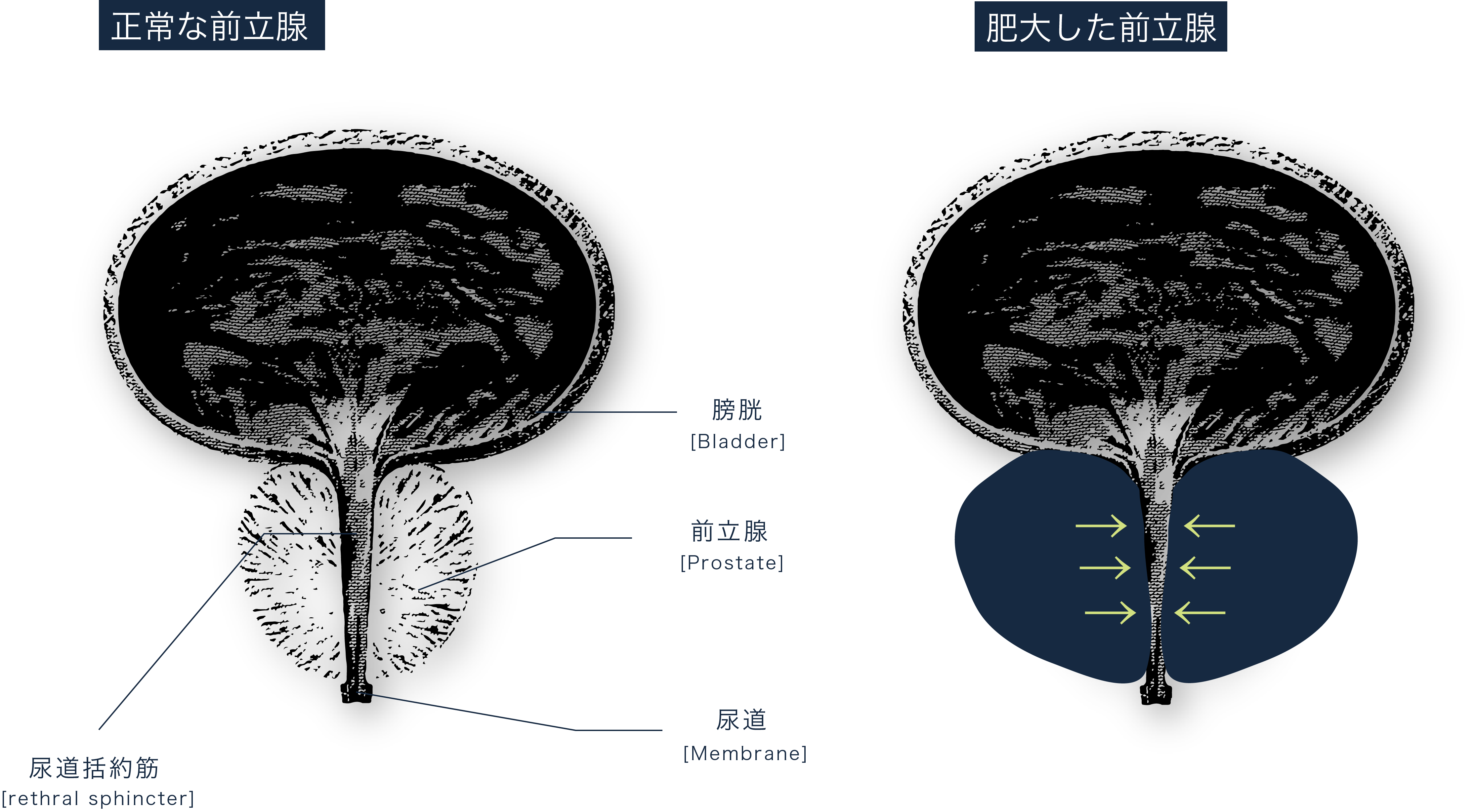 前列腺增生